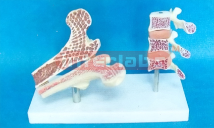 GIANT MORBIDITY COMPARISONS MODEL FOR LUMBAR VERTEBRAL WITH 3-STAGE AND FEMUR BONE